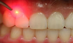 Picture of a dental laser treatment by Premier Holistic Dental in London.